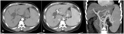Non-cirrhotic portal hypertension secondary to cholangiointestinal anastomotic stricture after choledochal cyst excision: a case report